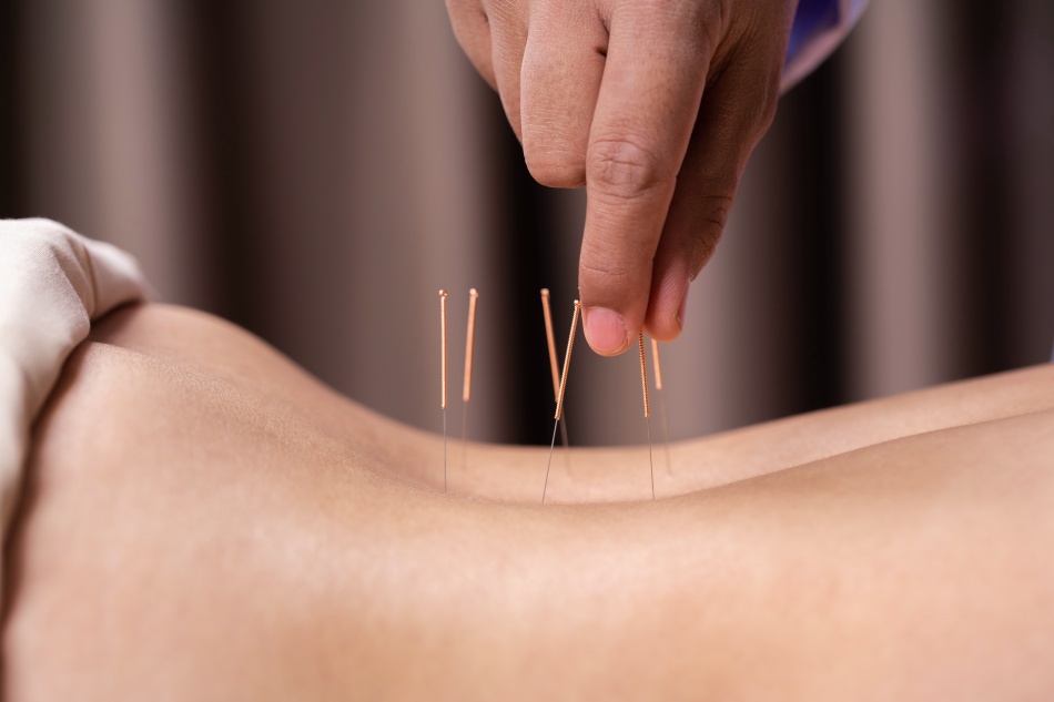 akupunktur bei rueckenschmerzen